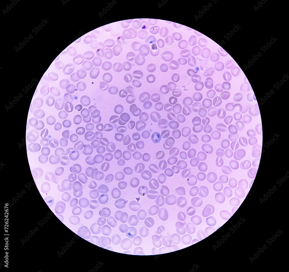 Wall mural Close view of Reticulocyte count under microscope, 40x. methylene blue staining