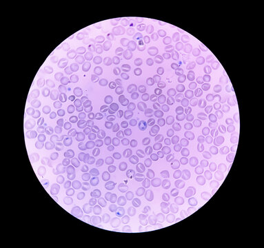 Close view of Reticulocyte count under microscope, 40x. methylene blue staining