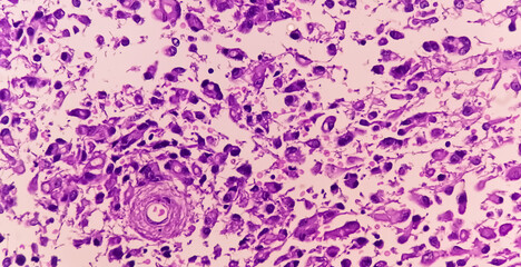 Photomicrograph of Histological analysis of Intramedullary SOL showing Astrocytoma, WHO grade-4