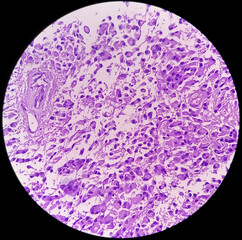 Photomicrograph of Histological analysis of Intramedullary SOL showing Astrocytoma, WHO grade-4