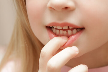 Fototapeta premium Cute preschool girl showing a loose primary (baby) tooth 