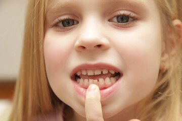 Cute preschool girl showing a loose primary (baby) tooth 