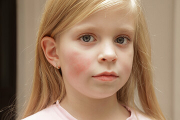 Redness on child's cheeks caused by eczema, dry skin or allergy 