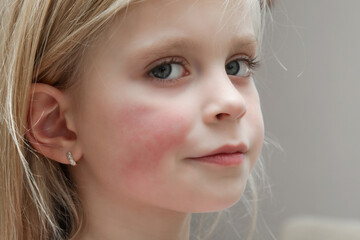 Redness on child's cheeks caused by eczema, dry skin or allergy 