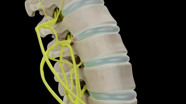 A herniated disc protrusion enlarges compressing a nerve root and causing pain. 3D animation isolated on a black background