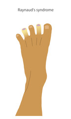 Fototapeta premium A foot with Raynaud's syndrome symptoms on tips of the toes. Peripheral cyanosis shown as white and discoloured toes. 