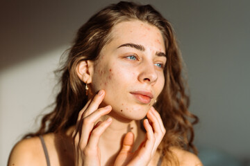Young woman touching a pimple on her face, feeling annoyed because of problems with skin....