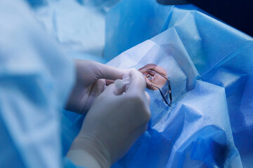 Process lasik treatment, laser vision correction. Doctor use equipment for fixing eyeball, patient...