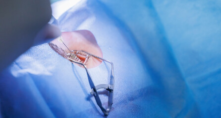 Process laser vision correction, lasik treatment. Doctor use equipment for fixing eyeball, patient...