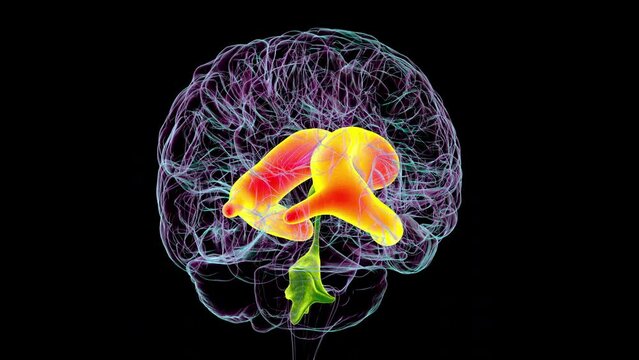 Enlarged lateral ventricles of the brain (hydrocephalus), 3D animation.