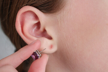 The teenager tore off his earlobe with an earring. The wound on the ear. - obrazy, fototapety, plakaty