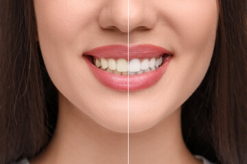 Woman showing teeth before and after whitening, collage