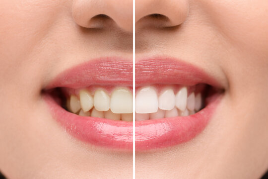 Woman showing teeth before and after whitening, collage