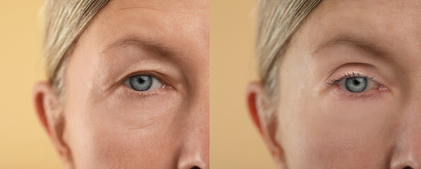 Aging skin changes. Woman showing face before and after rejuvenation, closeup. Collage comparing skin condition - obrazy, fototapety, plakaty
