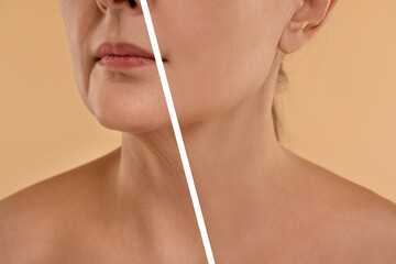 Aging skin changes. Woman showing neck before and after rejuvenation, closeup. Collage comparing skin condition - obrazy, fototapety, plakaty
