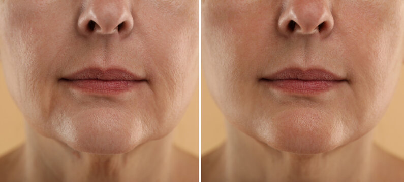 Aging skin changes. Woman showing face before and after rejuvenation, closeup. Collage comparing skin condition