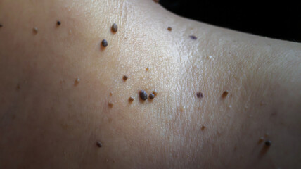 High-resolution close-up image showcasing skin tags, also known as acrochordon, on the neck of a...
