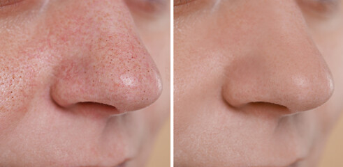 Blackhead treatment, before and after. Collage with photos of woman, closeup view - obrazy, fototapety, plakaty