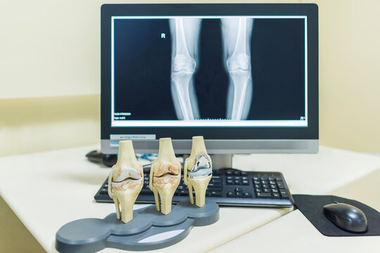 Model of knee joint shows osteoarthritis of knee and total knee prosthesis replacement surgery.X-ray both knees in computer.Joint pain refers orthopedic surgeon.Patient education in examination room.