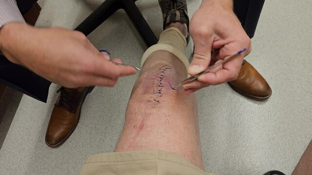 Closeup-Doctor removing stitches from knee following surgical knee replacement