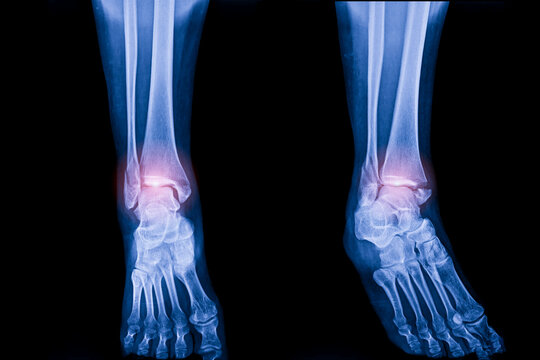 Ankle x ray after accident in orthopedic unit inside trauma hospital.X-ray shows ankle bone fracture.Patient needs surgery.Xray technology in blue on black background.Red light effect.Ankle twist.