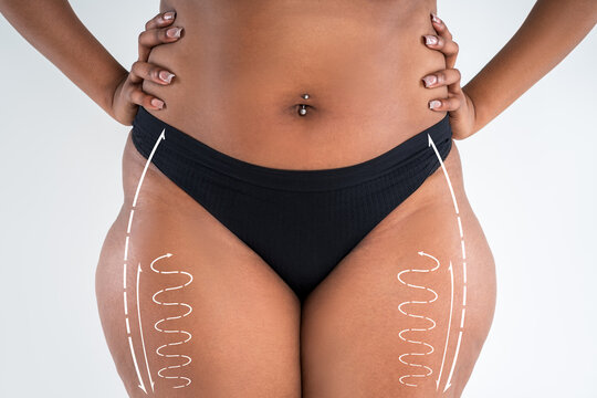 Legs and hips liposuction, fat and cellulite removal concept, overweight female body with surgical lines and arrows, black African woman on gray background, plastic surgery
