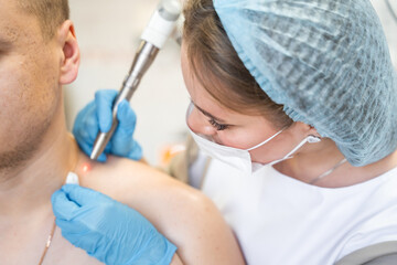 Dermatologist removes skin tumors with a laser, the process of removing skin diseases