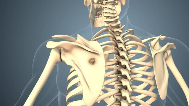Cancer spreading along a scapula bone