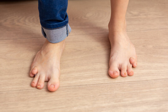 Close-up of the feet of a thirteen-year-old girl with a birth defect.