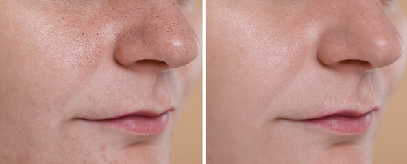 Obraz premium Blackhead treatment, before and after. Collage with photos of woman, closeup view