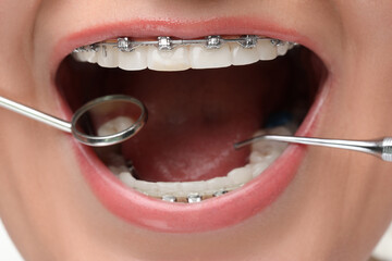 Examination of woman's teeth with braces using dental tools, closeup