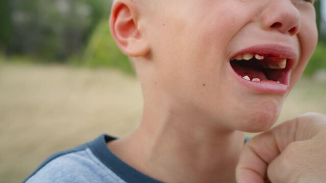 The boy cries a lot after one of his front baby teeth was pulled out with a thread. Baby crying, pain. fear and anxiety. A change of teeth in a child.