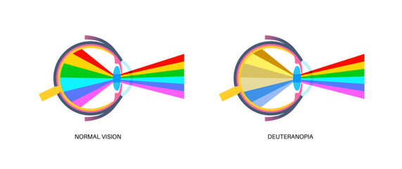 Deuteranomaly and deuteranopia