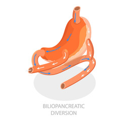 3D Isometric Flat  Illustration of Types Of Bariatric Surgery. Item 1