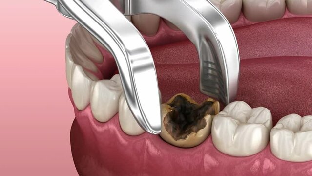 Dental Health animated Techniques for Pulling Out tooth decay