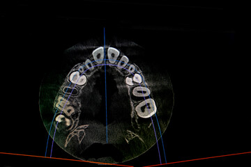 CT image of the teeth of a 9-year-old child, with baby teeth, in different projections. CBCT of two...