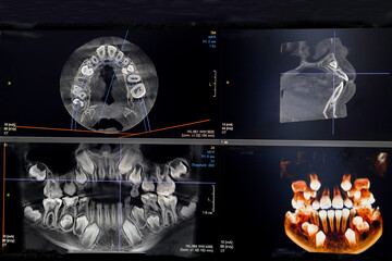 CT image of the teeth of a 9-year-old child, with baby teeth, in different projections. CBCT of two jaws. - obrazy, fototapety, plakaty