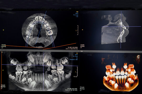 CT image of the teeth of a 9-year-old child, with baby teeth, in different projections. CBCT of two jaws.