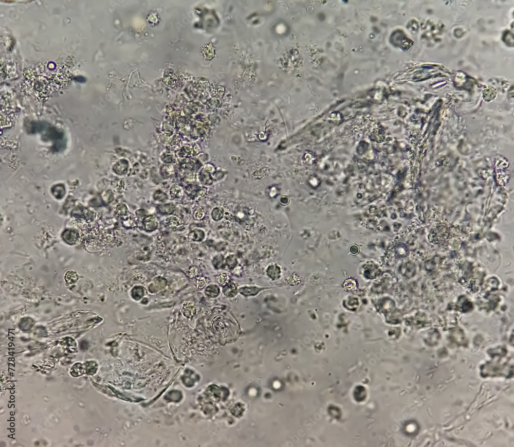 Wall mural Sputum smear without stain under microscopy showing pus cells