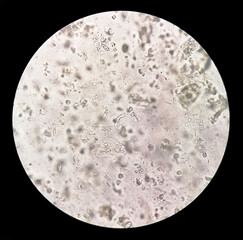 Sputum smear without stain under microscopy showing pus cells