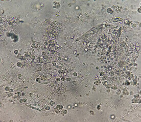 Sputum smear without stain under microscopy showing pus cells