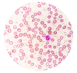 Suggestive of megaloblastic anemia to rule out Pernicious anemia (giant band, hyper segmented...