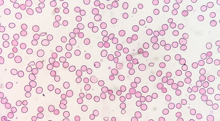 Suggestive of megaloblastic anemia to rule out Pernicious anemia (giant band, hyper segmented nucleus and myelocyte)., microscopic exam