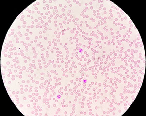 Suggestive of megaloblastic anemia to rule out Pernicious anemia (giant band, hyper segmented...