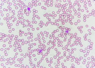 Suggestive of megaloblastic anemia to rule out Pernicious anemia (giant band, hyper segmented...