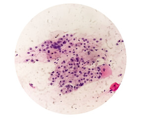 Photomicrograph of Paps smear showing Mild dysplasia (LSIL)