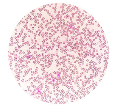 Suggestive of megaloblastic anemia to rule out Pernicious anemia (giant band, hyper segmented nucleus and myelocyte)., microscopic exam