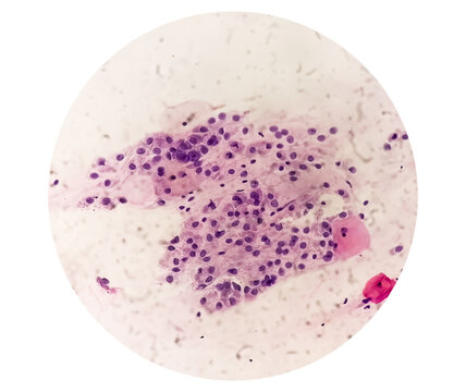 Photomicrograph of Paps smear showing Mild dysplasia (LSIL)