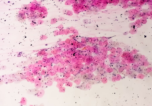 Photomicrograph of Paps smear showing Mild dysplasia (LSIL)