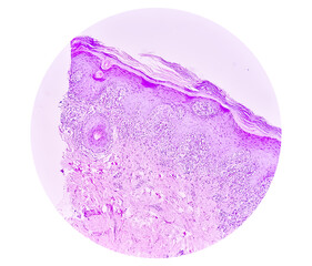 Photomicrograph of Skin tissue biopsy showing Lichen planus. T-cell mediated autoimmune disorder.